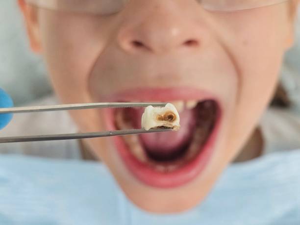 Best Emergency Treatment for Toothache in Carthage, TX